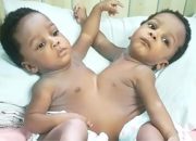 The Story Of How Twins Joined At The Chest And Abdomen Were Split In Abuja Nigeria (Photos)